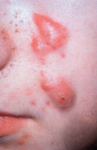 Acne Cysts