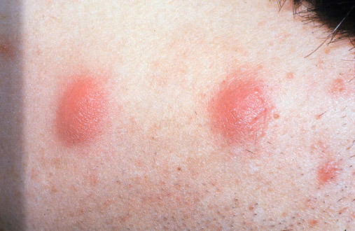 Acne Nodules