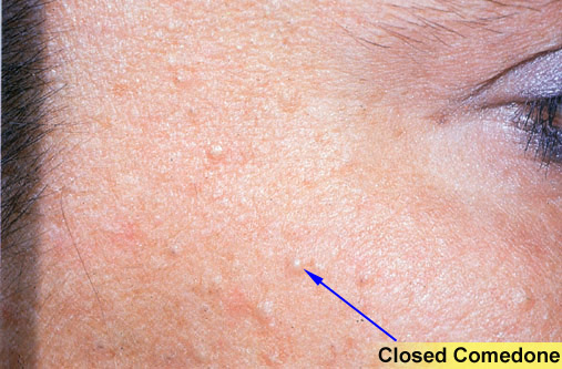 closed comedone treatment #10