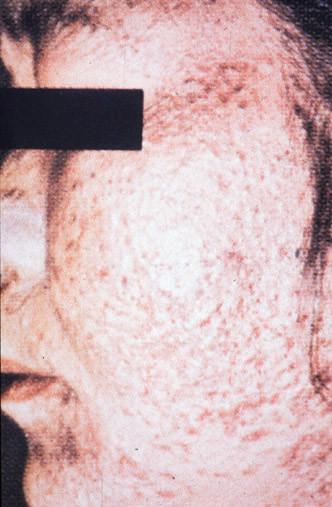 Comedonal Acne