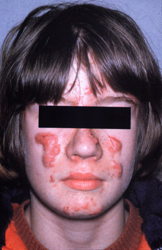 Cystic Acne