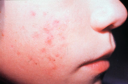 Mild Papular Acne