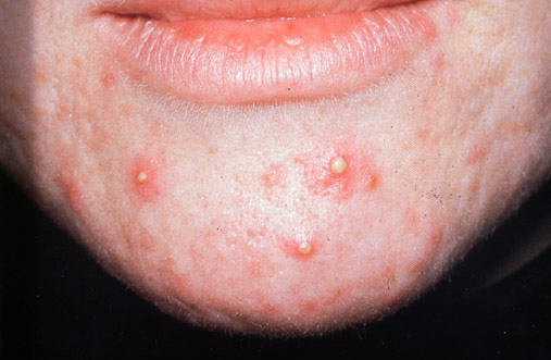 Pustules : MedlinePlus Medical Encyclopedia