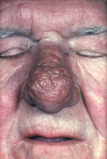 Rhinophyma