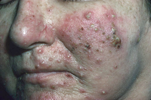 Rosacea (Pre-treatment)