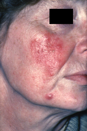 Rosacea