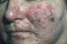 Rosacea