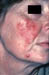 Rosacea