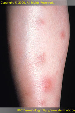 Erythema nodosum