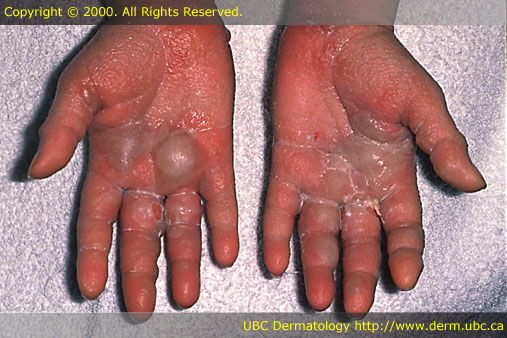 Allergic contact dermatitis 