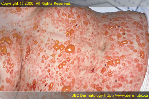 Bullous pemphigoid