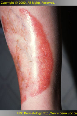 Necrobiosis lipoidica