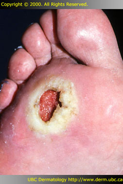 Diabetic ulcer