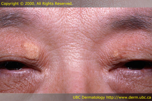 Xanthelasma