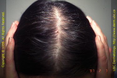 Androgenetic Alopecia (Female)