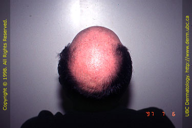 Androgenetic Alopecia (Stage VII)