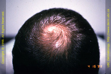 Androgenetic Alopecia (Stage 3V)
