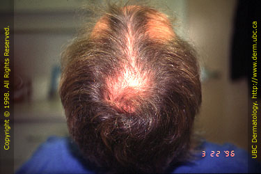 Androgenetic Alopecia (Stage IV)