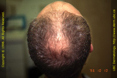 Androgenetic Alopecia (Stage V)