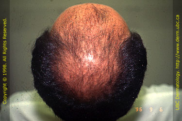 Androgenetic Alopecia (Stage VI)