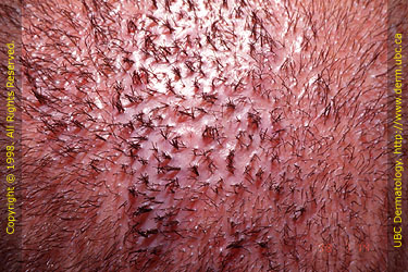 Tufted folliculitis