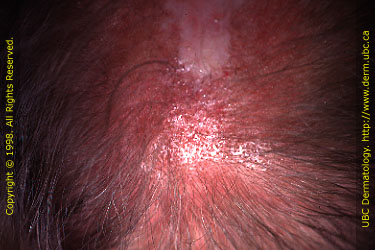 Discoid lupus of the scalp
