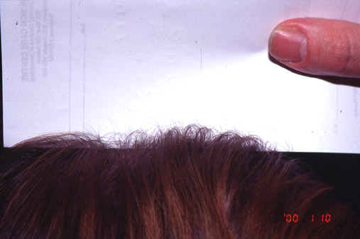 Androgenetic alopecia (AGA)