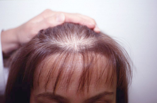 Female Androgenetic alopecia (AGA)