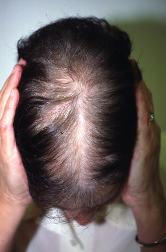 Effluviums - American Hair Loss Association