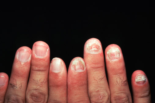 Onychomycosis of the fingers of one hand only