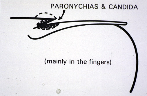 Paronychias and Candida