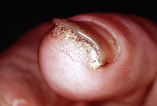 Psoriasis Nail Dystrophy
