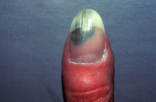 Pseudomonas of the nails.