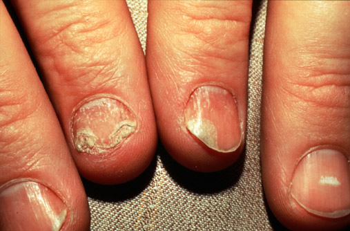 onycholysis psoriasis