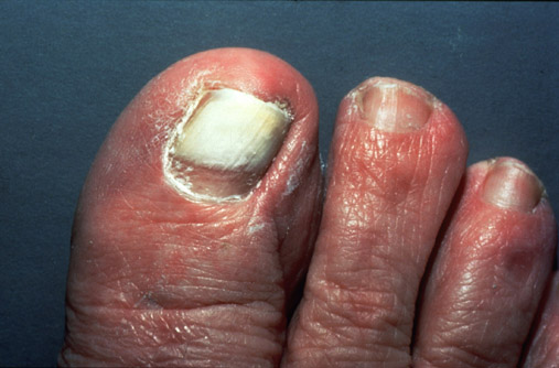 Onychomycosis