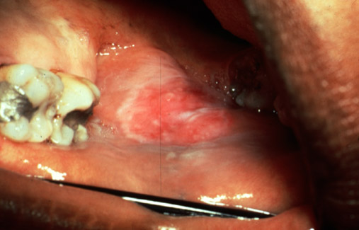 Discoid Lupus Erythematosus: Background, Etiology ...