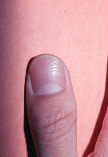Nail pitting of psoriasis
