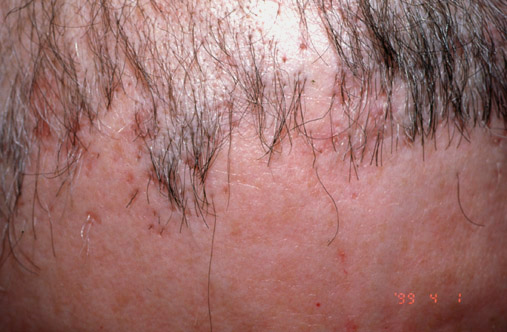 Loss of follicular ostia