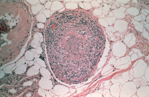 Histopathology of Alopecia areata