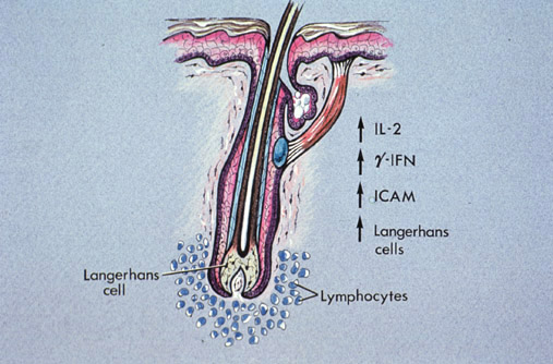 Pathogenesis of Alopecia areata