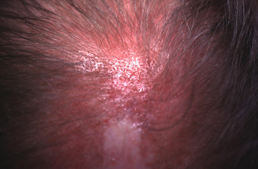 lupus scalp #10