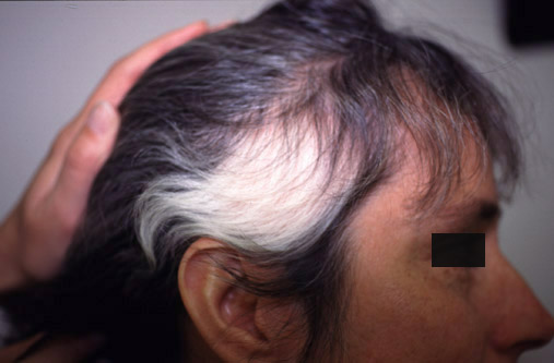 white scalp in hair