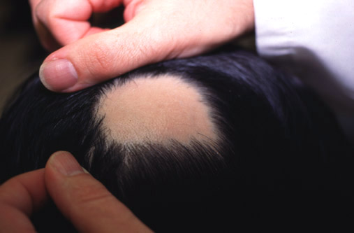 Alopecia areata circumscripta