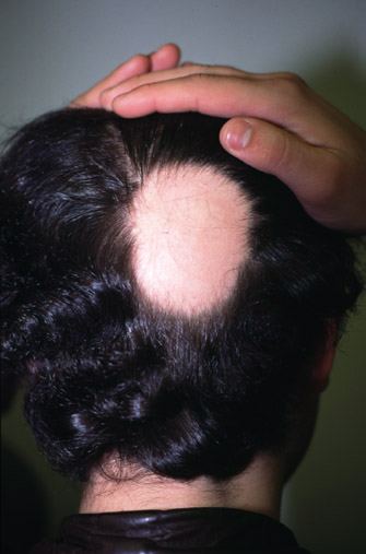 Alopecia areata (AA)