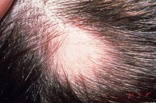 Alopecia areata circumscripta