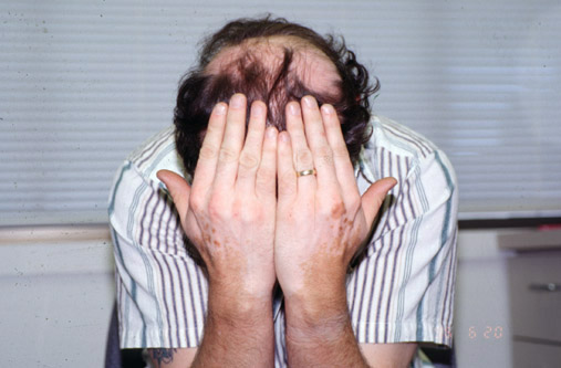 Alopecia areata (AA) and Vitiligo