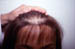 Female Androgenetic alopecia (AGA)