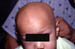 Alopecia universalis