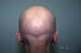 Alopecia universalis