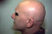 Alopecia universalis